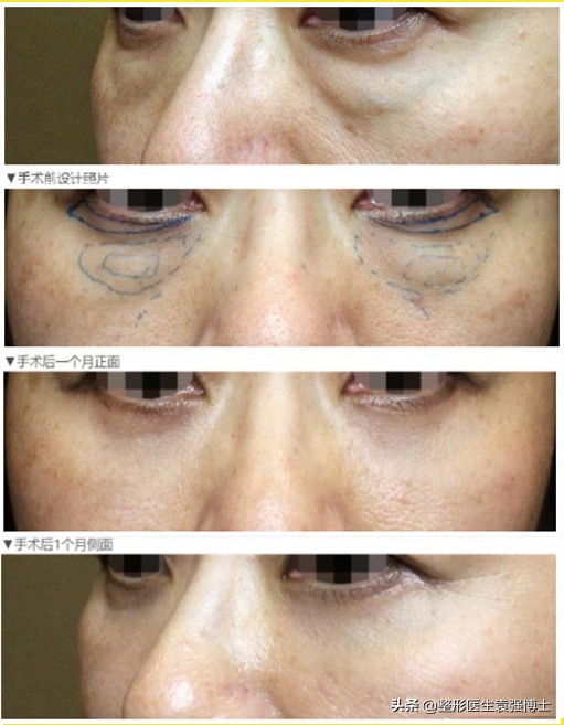 做眼袋都需要问医生什么问题,做手术前要咨询医生哪些问题