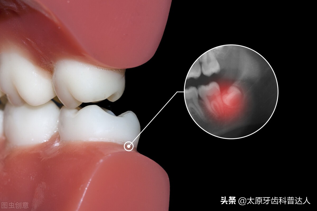 牙痛迁延不愈如何才能有效缓解,牙痛反反复复不得好怎么办
