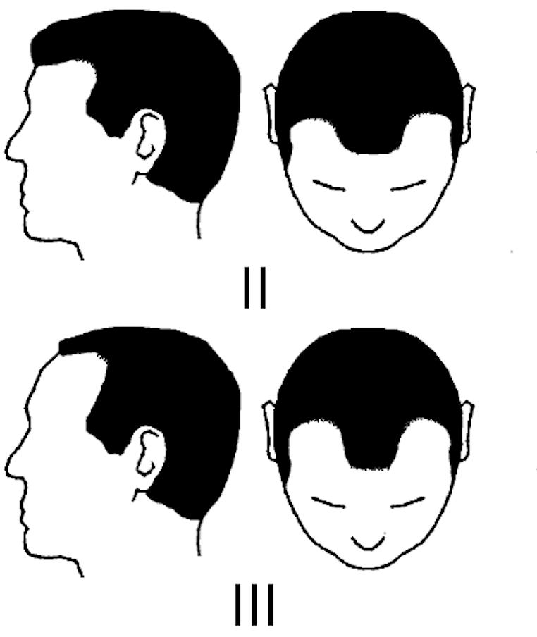 人到中年不得已都开始秃顶了,中年男人的三大危机秃顶发福