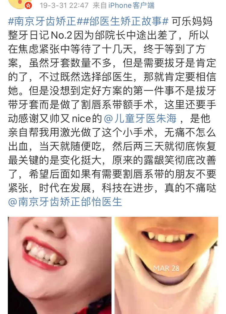 正畸医生邰怡的作品,南京牙齿矫正邰医生