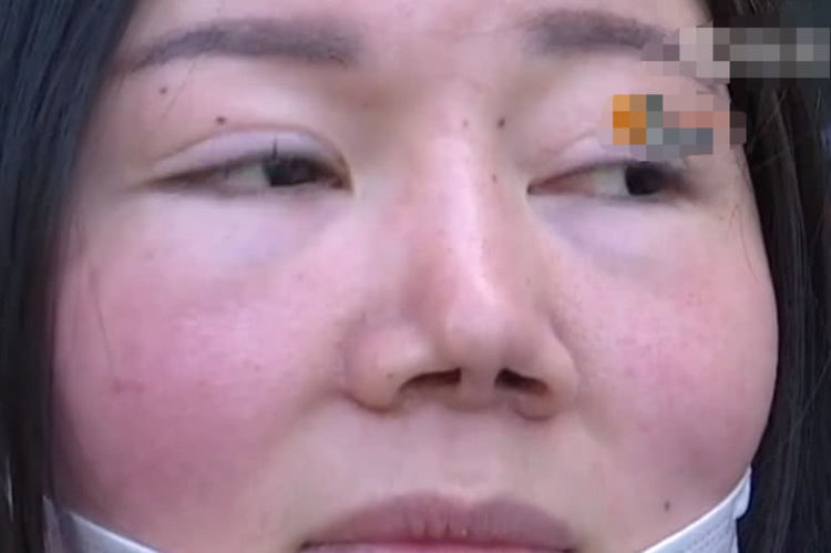 女子鼻子整容失败,女子鼻子整形