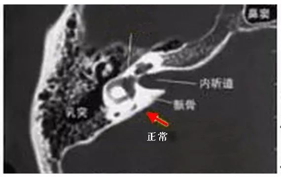 突然耳聋治愈率是多少,青岛耳聋去哪治疗