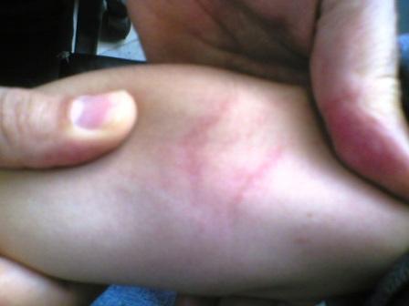 猩红热出完疹子还是发烧怎么回事,发热咽痛出荨麻疹