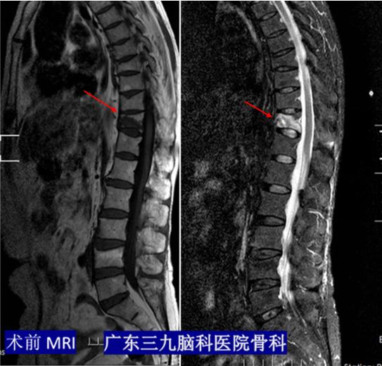 老年人骨头断裂是什么原因,老年人骨头断了怎么好得快