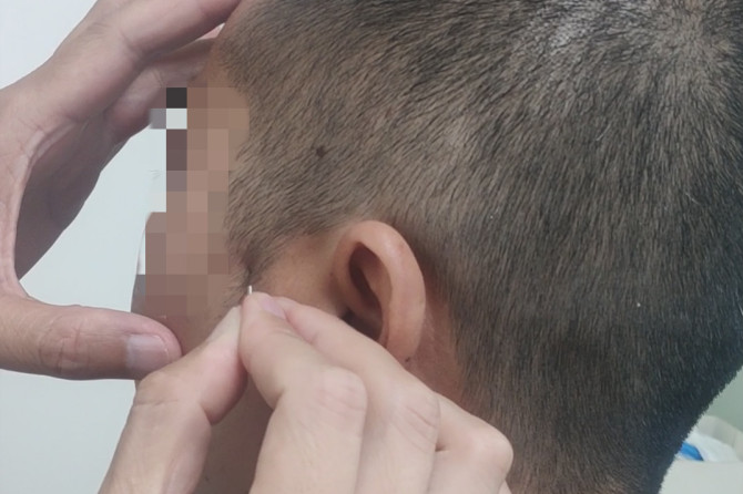 医院耳鼻喉科怎么治急性鼻炎,耳鼻喉医院鼻炎特效药