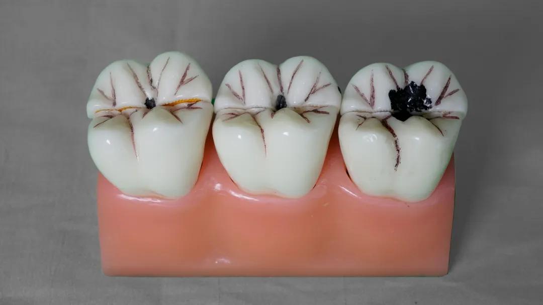 根管治疗是不是就是杀死神经,根管第一次封药是杀神经吗