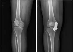 膝关节骨性关节炎到底该怎么治？这篇全说透了