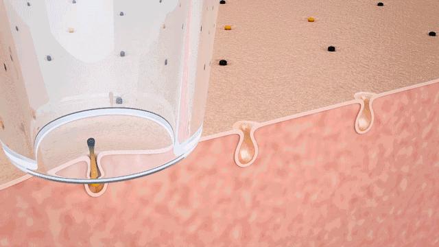 清理黑头最好用的办法,去黑头的最好方法不用清洁