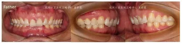 牙齿深覆合对脸型的影响,覆合型牙齿是怎么造成的