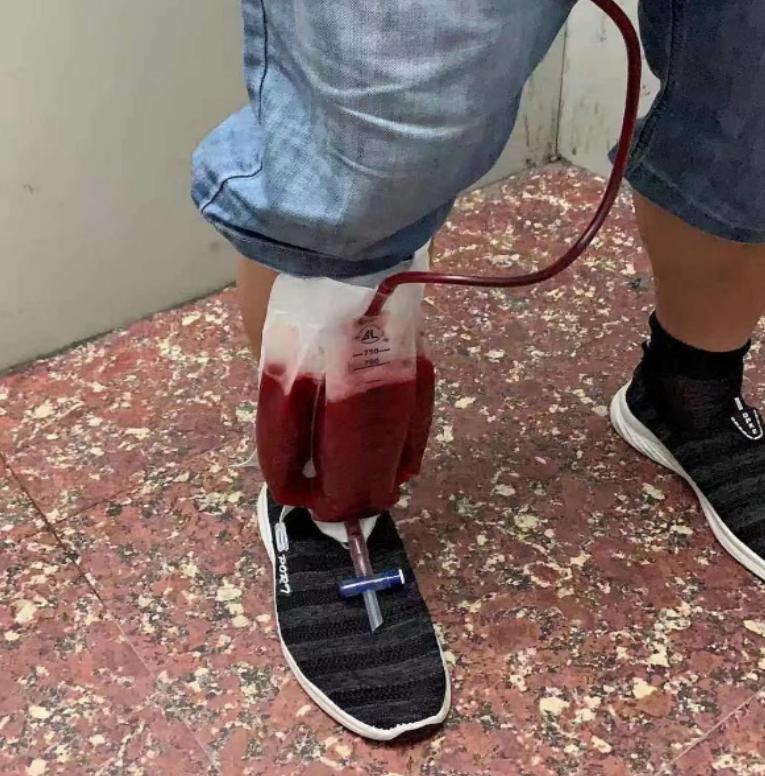 56岁男性发现双肺数百个结节,肺部肿块伴胸腔积液