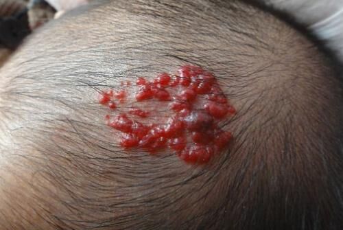 血管瘤鲜红斑痣是什么原因造成的,鲜红斑痣是不是比血管瘤厉害难治