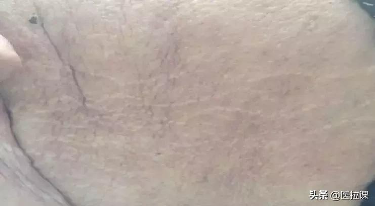 护理学注射法名词解释,基础护理学注射法视频