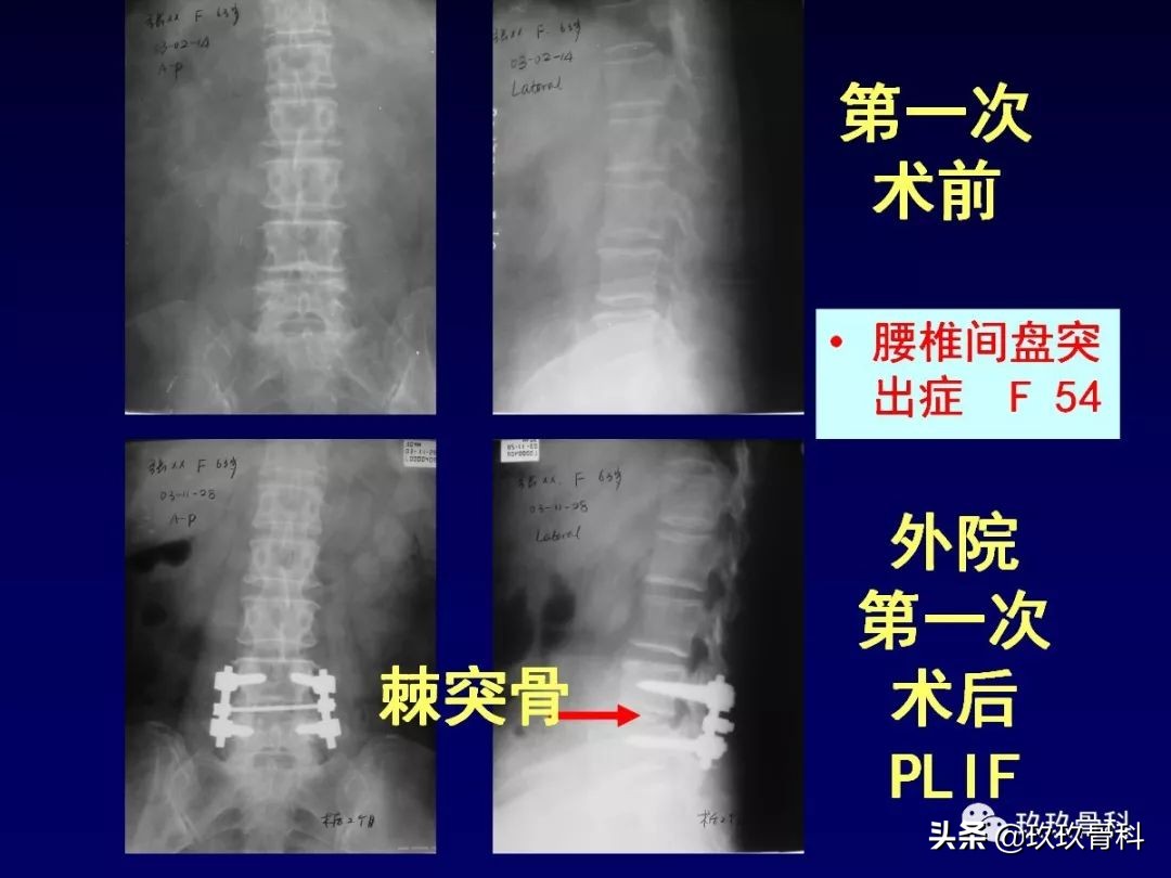 腰椎不稳最坏的结果,腰椎不稳的最佳治疗方法