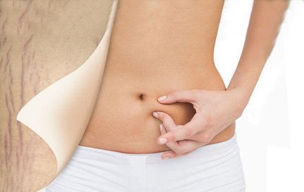 为什么别人怀孕不长妊娠纹?孕期防纹做好这4点,拒绝西瓜肚