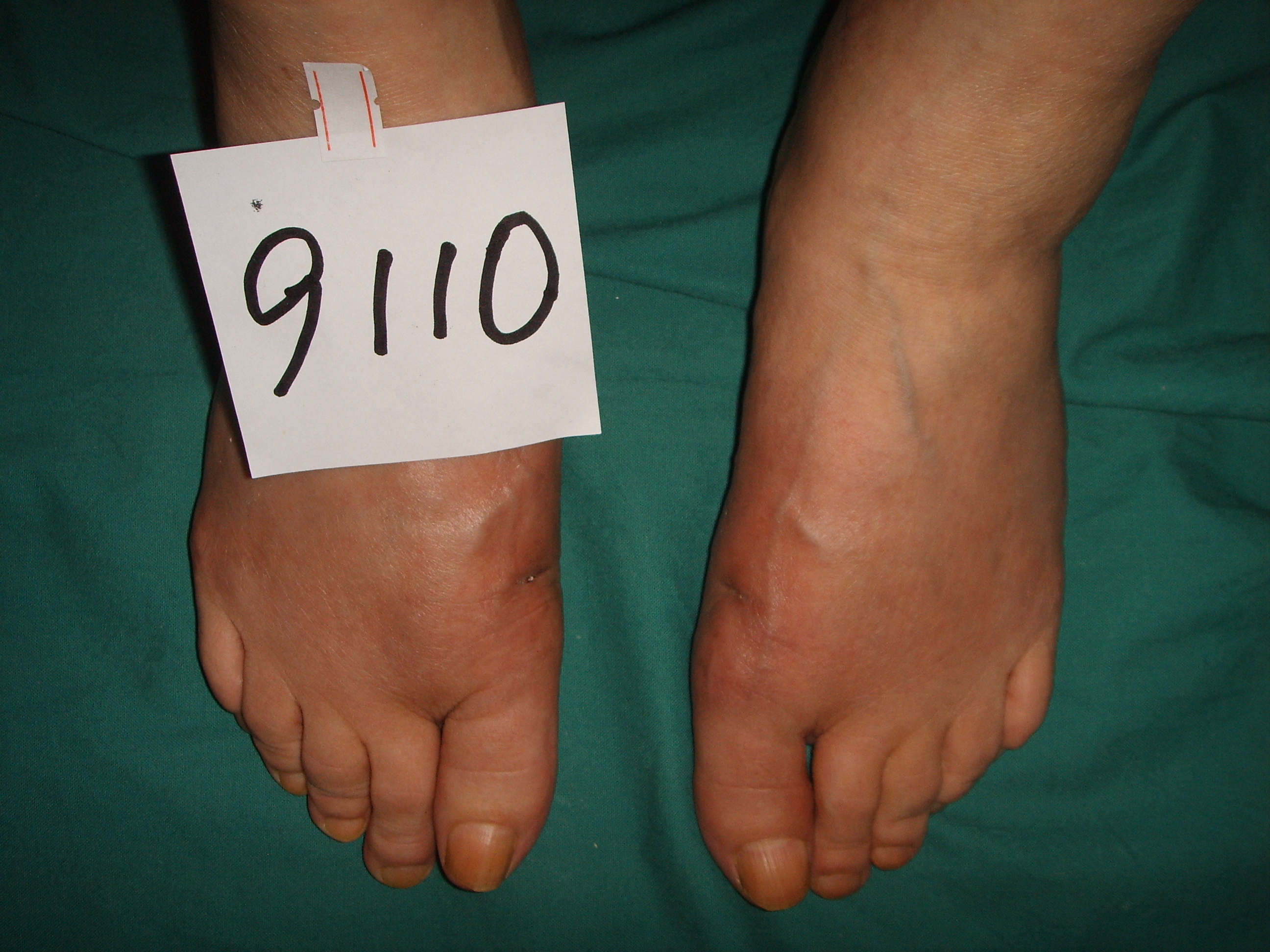 70岁有必要做腰椎手术吗,70岁老人做大脚骨手术可行吗