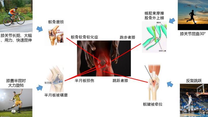 膝关节肿胀变形的照片,膝关节疼痛还可以运动吗