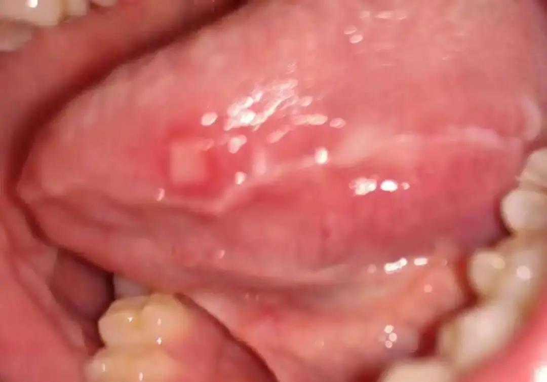 反复口腔溃疡竟被查出癌症,深圳男子口腔溃疡导致舌癌