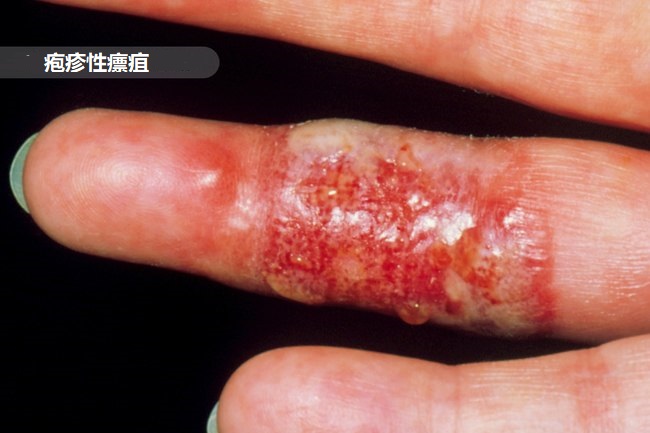 手指肿胀要警惕三种病,手指肿胀是10种疾病的警示信号