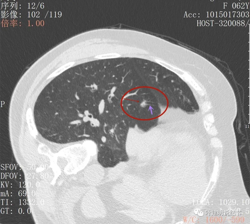 左肺癌手术半年右肺下角还有炎症,左下肺癌晚期