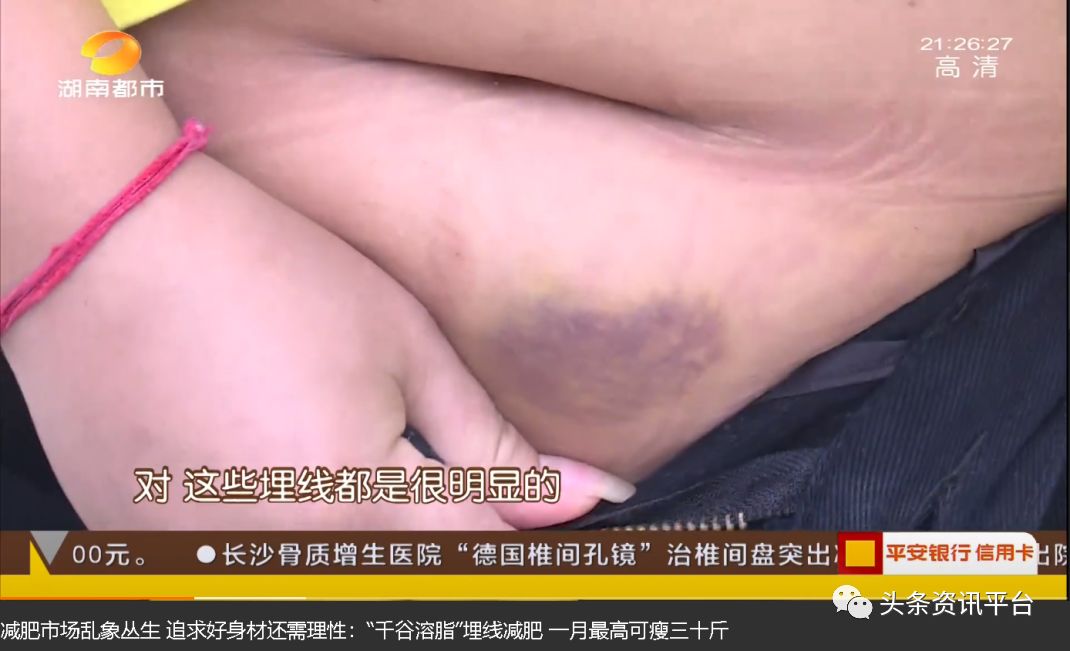 千谷德国溶脂线官网,千谷生物科技减肥