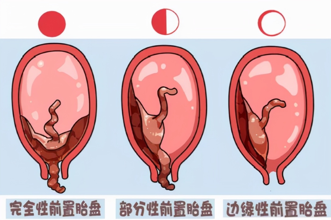 前置胎盘很凶怎么回事,前置胎盘真的有那么可怕吗