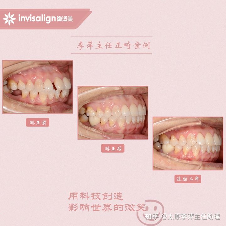 太原市牙齿正畸,太原市口腔正畸