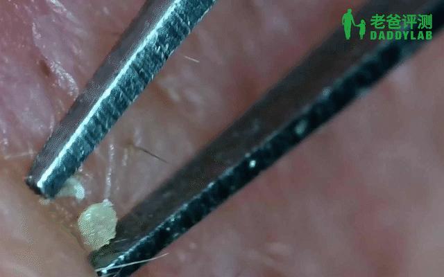 正确科学的去黑头方法一次说清楚,正确的去黑头的方法在这里