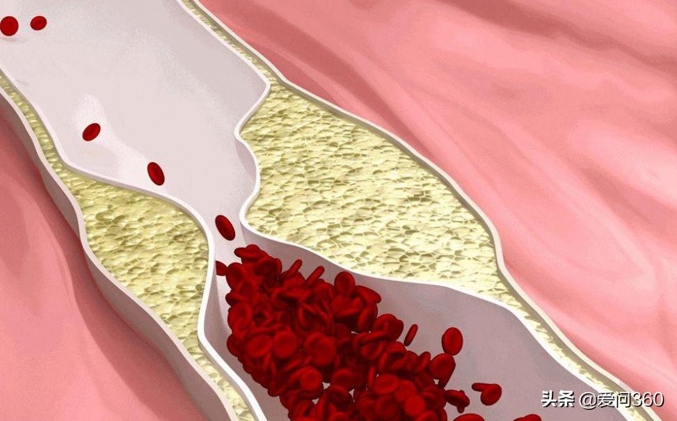 血管没有弹性什么原因该怎么治,血管失去弹性与血虚有关吗