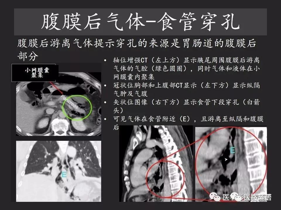 空腔脏器穿孔和胃肠道穿孔区别,腹膜后穿孔一般是哪里穿孔