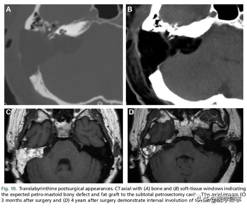 「综述」前庭神经鞘瘤的成像：诊断、监测、和治疗计划