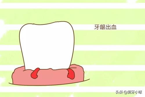 孕期护牙实用小知识,孕妇应怎么正确护理牙齿