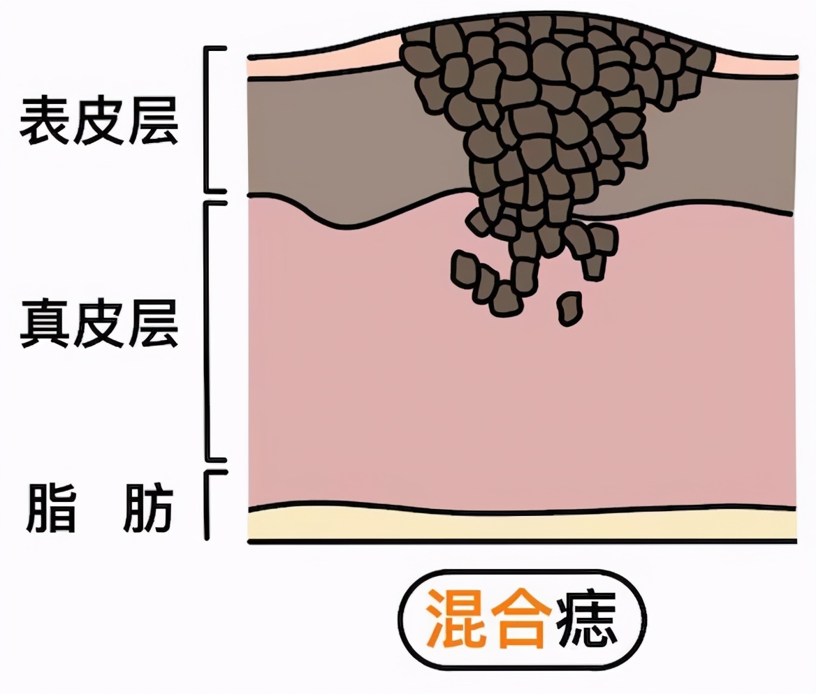 脸上多痣想祛除又怕留疤咋办,脸上切痣疤多久能消除
