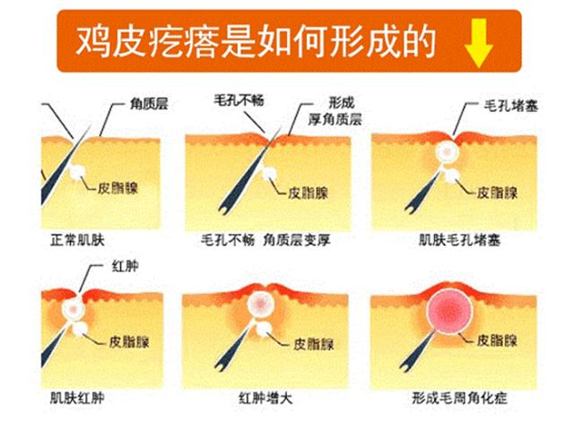 改善鸡皮肤身体乳果酸,果酸换肤改善鸡皮肤
