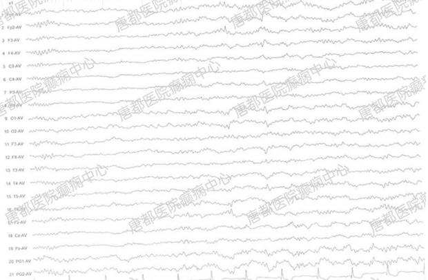 颞叶海绵状血管瘤癫痫微创手术,唐都医院脑肿瘤微创手术