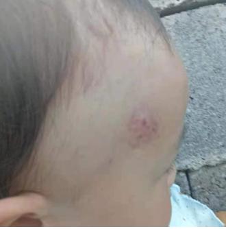 混合型血管瘤的治疗办法,混合型血管瘤的最佳治疗方法