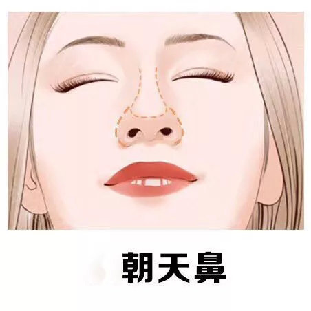 硅胶假体隆鼻透光怎么遮,硅胶隆鼻后鼻子反复肿