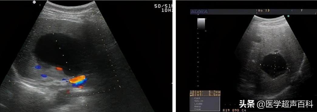 肝脏彩色超声检查报告单结果解释,肝脏超声检查报告单怎么看