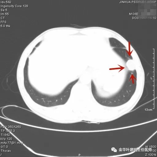 叶建明谈实性结节,叶建明肺实性良性结节会变癌症吗