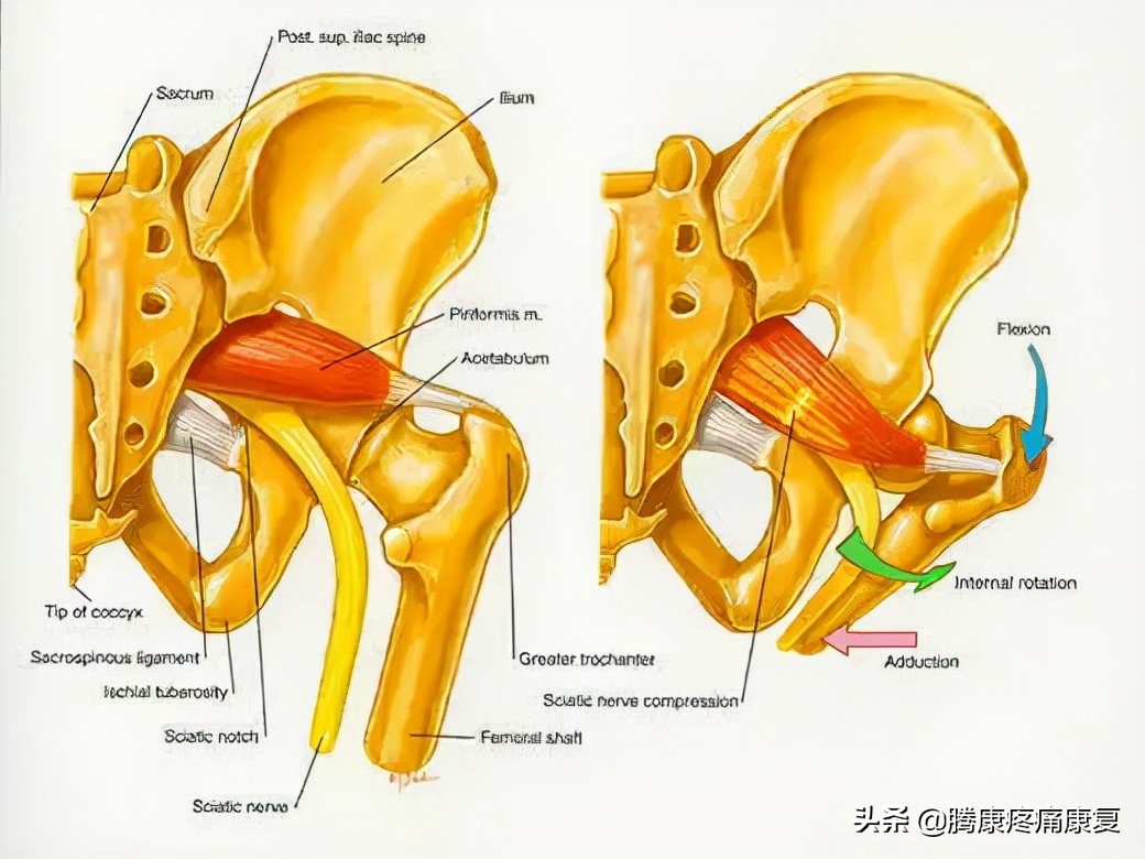 梨状肌综合征去哪个科诊断,梨状肌综合征的中医鉴别诊断