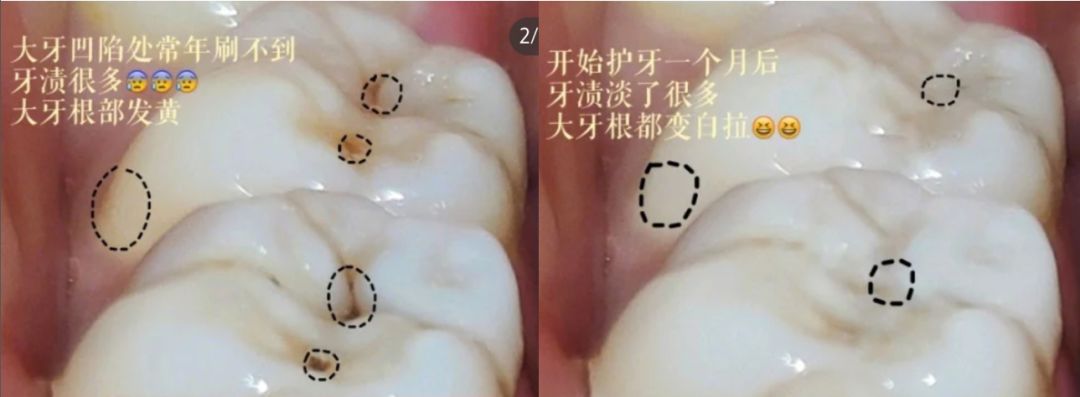 刘涛是全口瓷牙,演员刘涛的一口烤瓷牙多少钱
