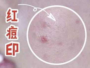 痘痘不挤痘印消不掉吗,红色痘印一直消不掉