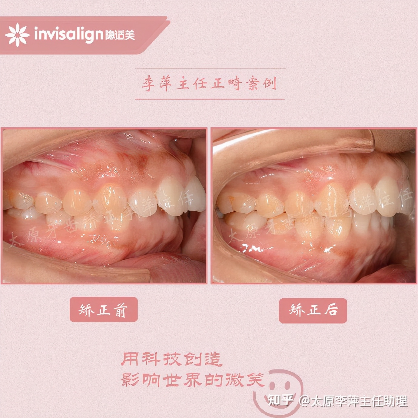 太原牙齿矫正靠谱吗,太原成人隐形牙套牙齿不齐