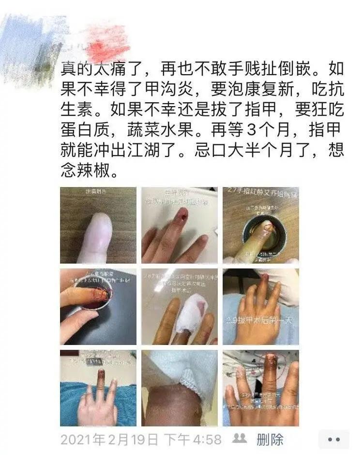 女星拔手指倒刺,女明星因拔倒刺住院