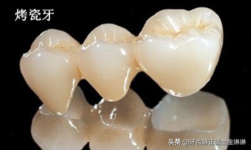 明星全口烤瓷牙的危害,明星为什么都做烤瓷牙