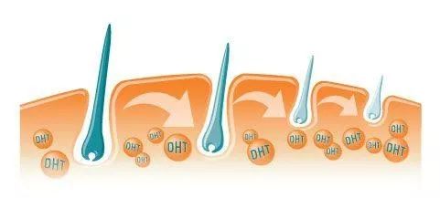 为什么种植头发要一年,种植出来的头发要多久才能长长