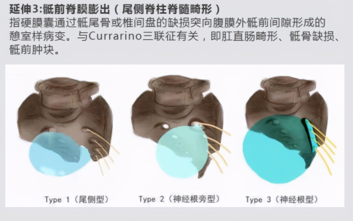 胎儿神经管闭合不全是什么原因,隐性神经管闭合不全