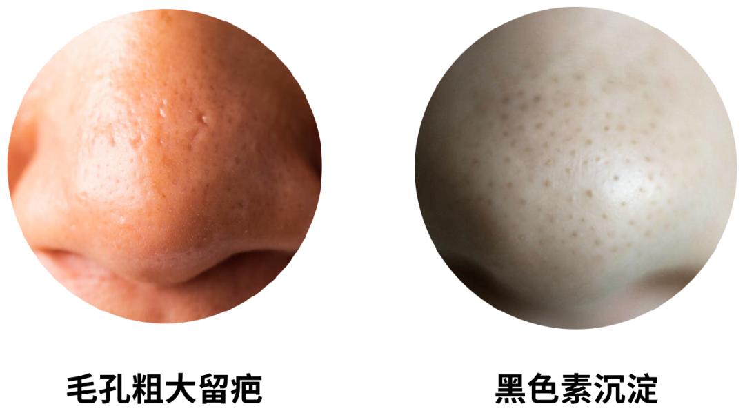 黑头毛孔粗大到底怎么治,黑头毛孔粗大有没有必要去改善