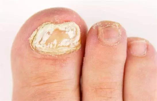 癣痒痒怎么办,癣痒怎么快速止痒