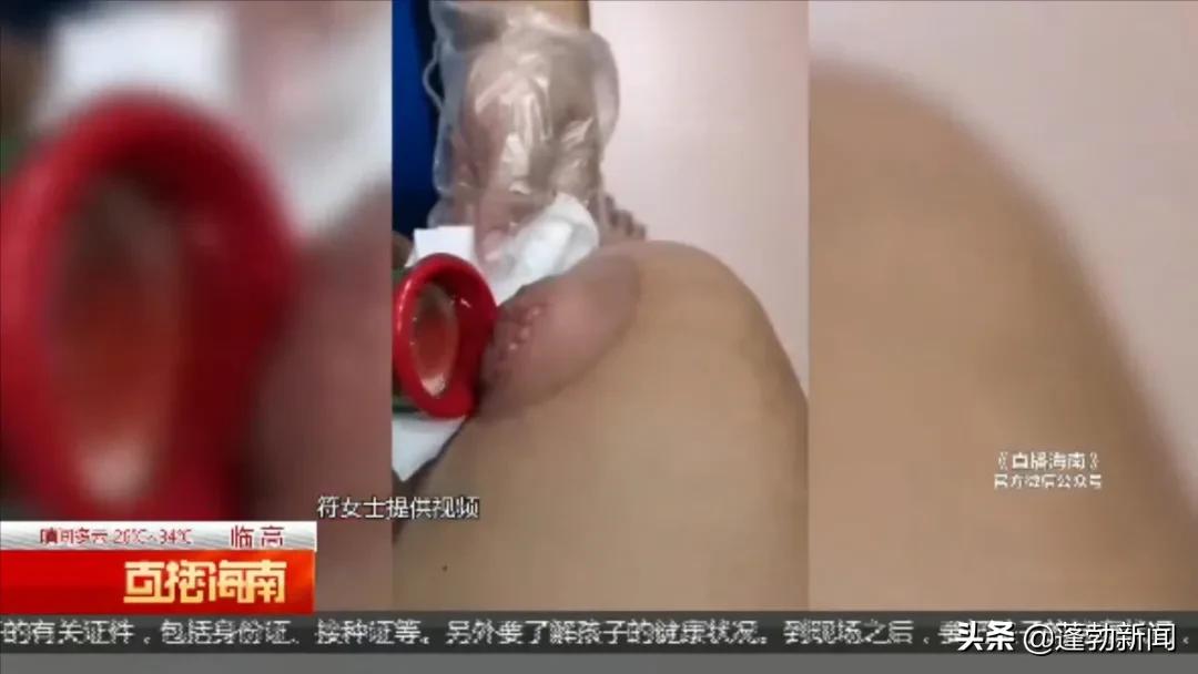 临高一村里开了家理疗馆,号称拔罐就能病除,真有这么神奇?