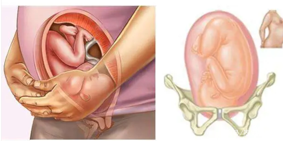 一分钟了解剖宫产视频,30秒了解剖宫产